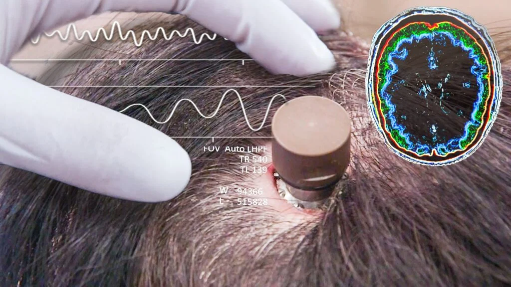 كيف ستغير شريحة الدماغ تيليباثي من نيورالينك وجه العالم إلى الأبد؟ 🧠 2 عرضت شركة نيورالينك (Neuralink) في عرضها الأخير أن شريحة الدماغ الخاصة بها جعلت هذا العصر الجديد من التكنولوجيا يبدو أكثر واقعية في بث مباشر منخفض الجودة بشكل غريب، يمكن لرجل مشلول تمامًا من الرقبة إلى الأسفل التحكم في جهاز الكمبيوتر تمامًا بعقله. ايلون ماسك سماها "تيليباثي" ولكن هل هذه الشريحة حقاً بالقوة الخارقة التي يقول عليها أم أنها مجرد مصطلح تسويقي لإخفاء الآثار الحقيقية لما قد تعنيه هذه التكنولوجيا؟